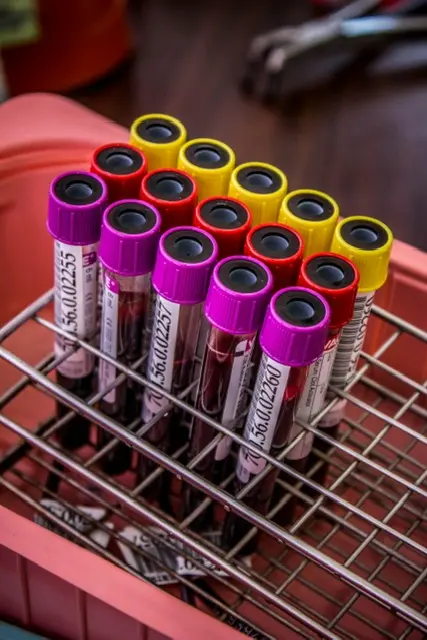 Probówki z próbkami krwi do analizy laboratoryjnej.webp
